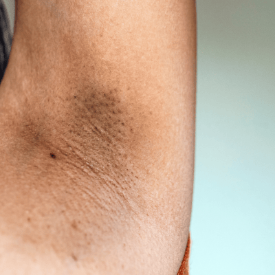 Koltuk Altı ve Genital Bölge Kararması Neden Olur? Nasıl Geçer?